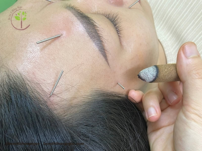 DỊCH VỤ CHÂM CỨU TẠI NHÀ CHO BỆNH NHÂN BỊ TAI BIẾN - Y TẾ ĐỨC HẠNH